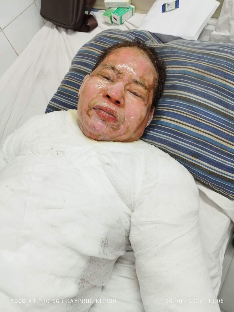 অবশেষে মৃত্যুর কাছে হার মানলো আগুনে দগ্ধ ইন্দ্রলাল তঞ্চঙ্গ্যা